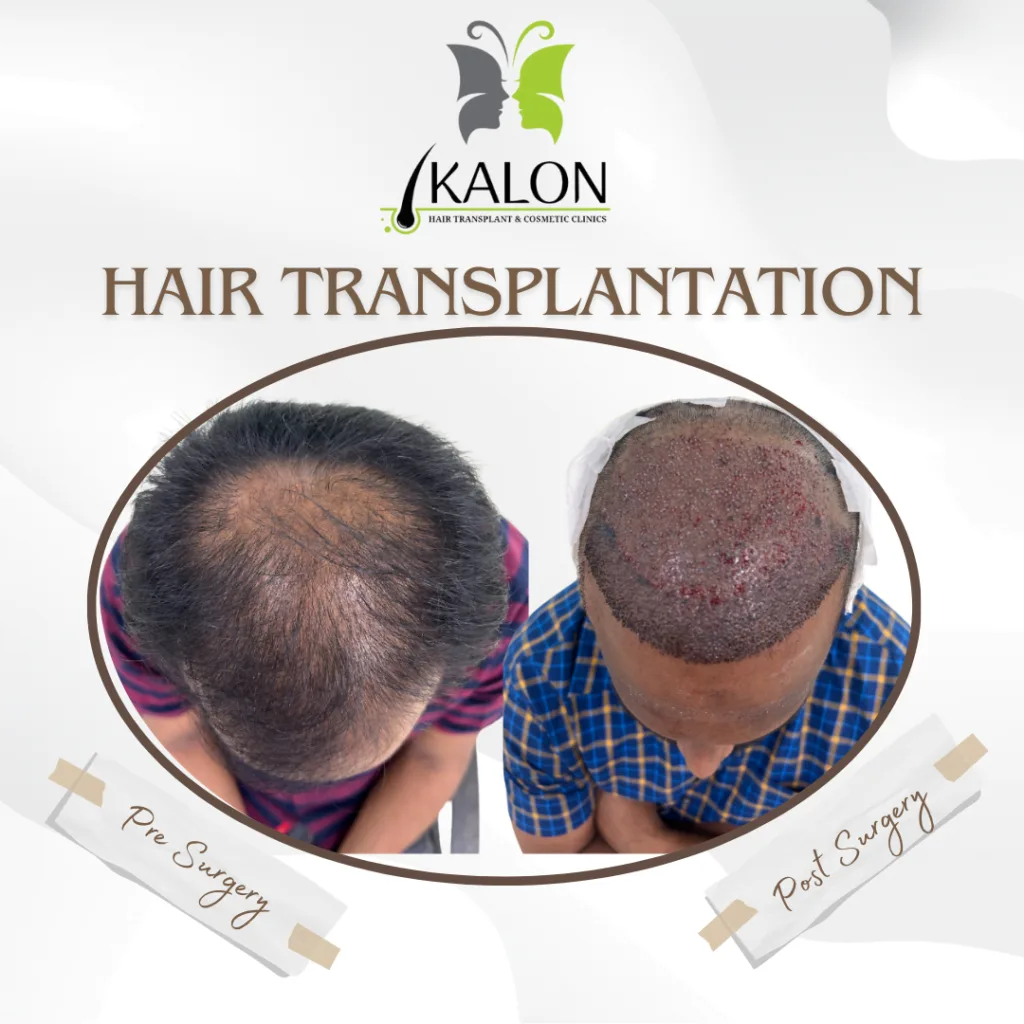 best hair transplant clinic in visakhapatnam