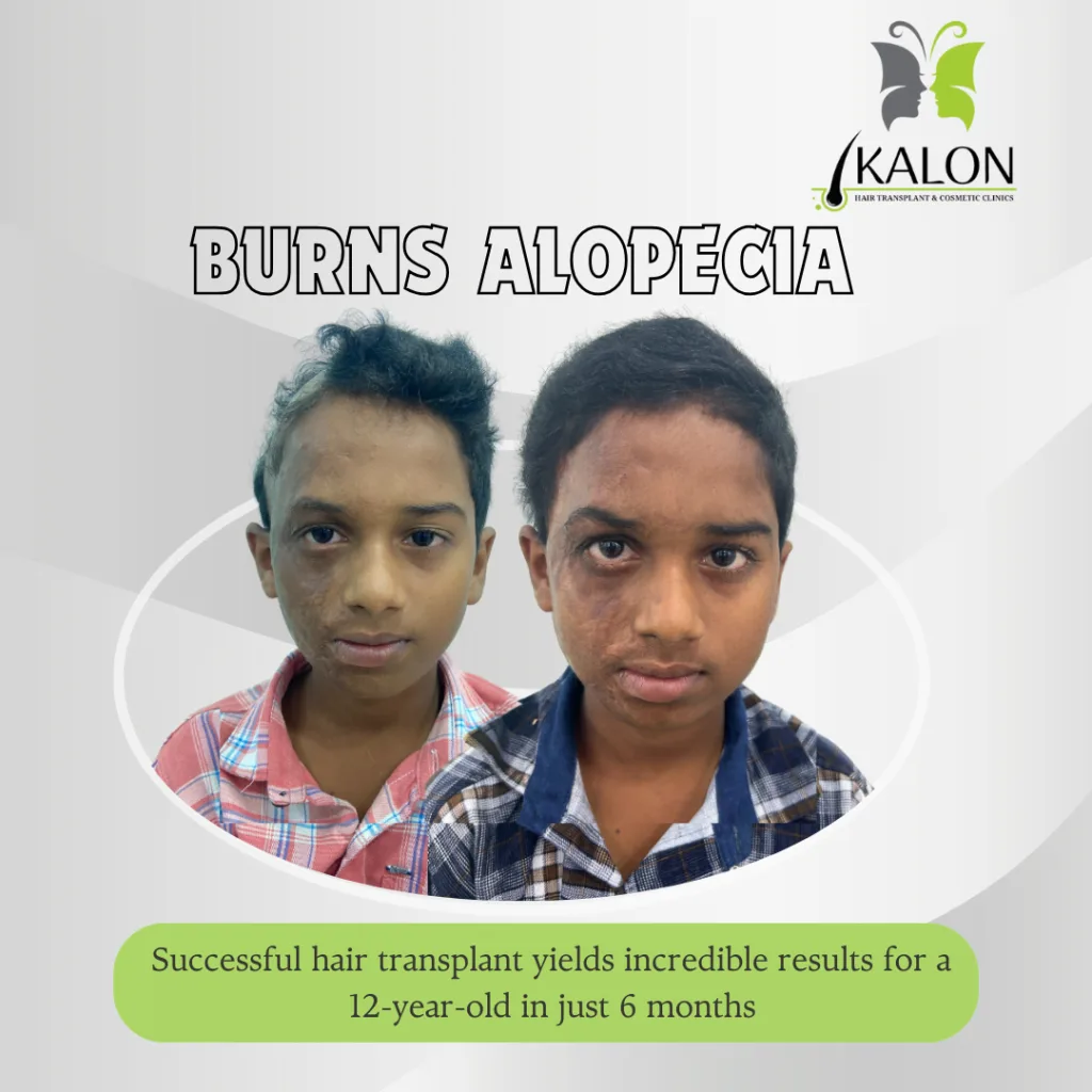 burn aloepatia