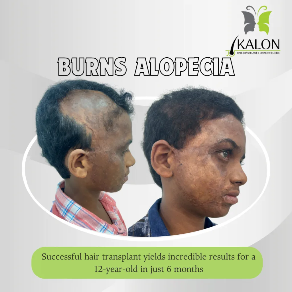 burn aloepatia