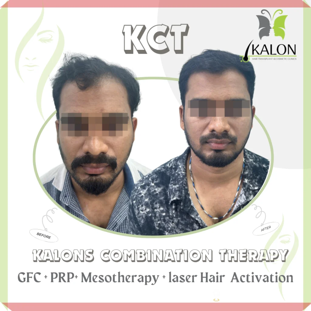 best hair transplant clinic in visakhapatnam
