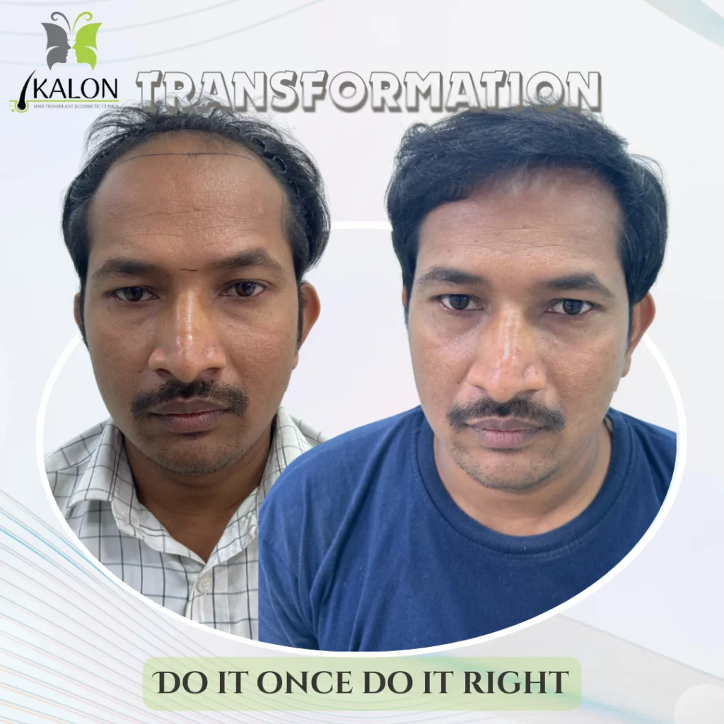 best hair transplant clinic in visakhapatnam