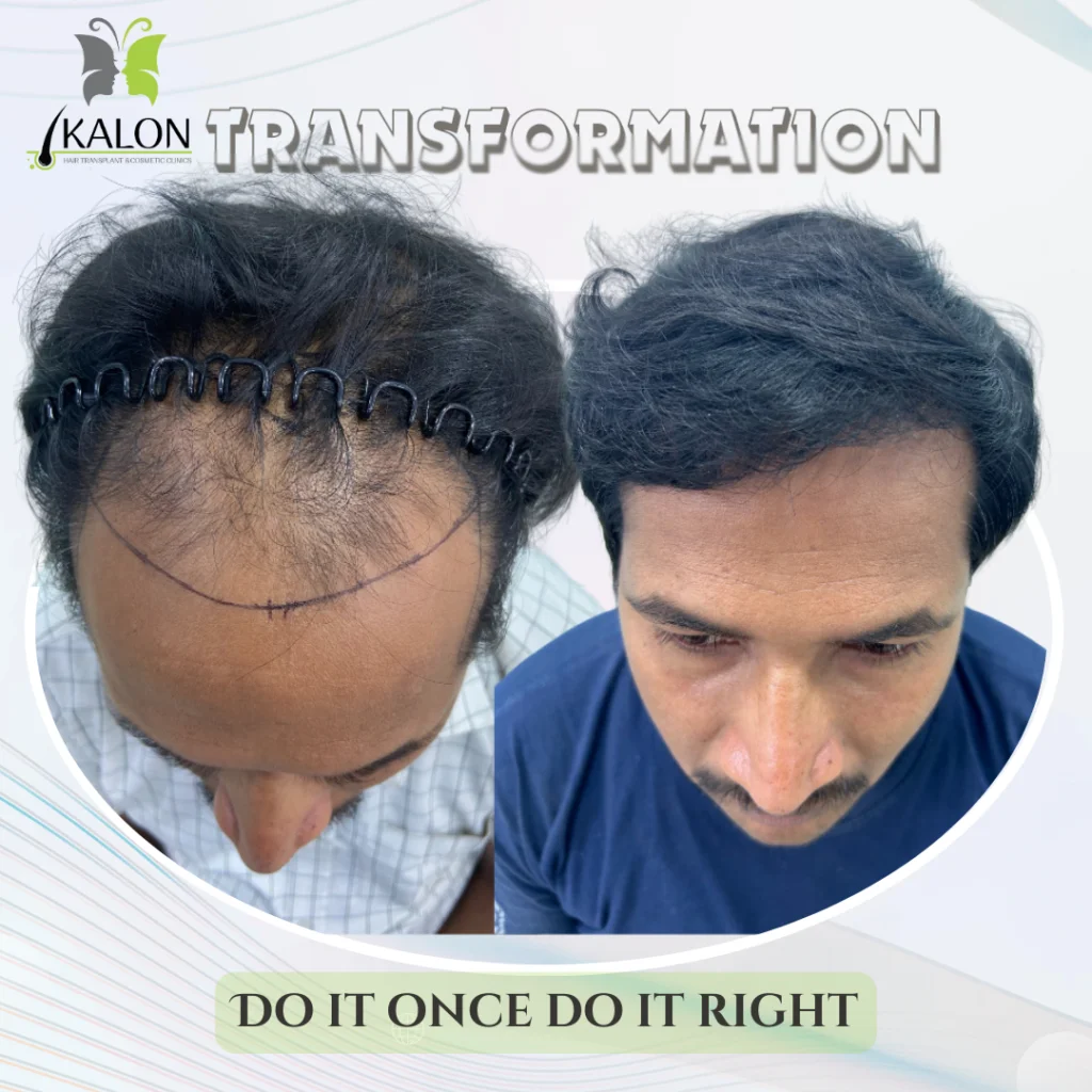 best hair transplant clinic in visakhapatnam