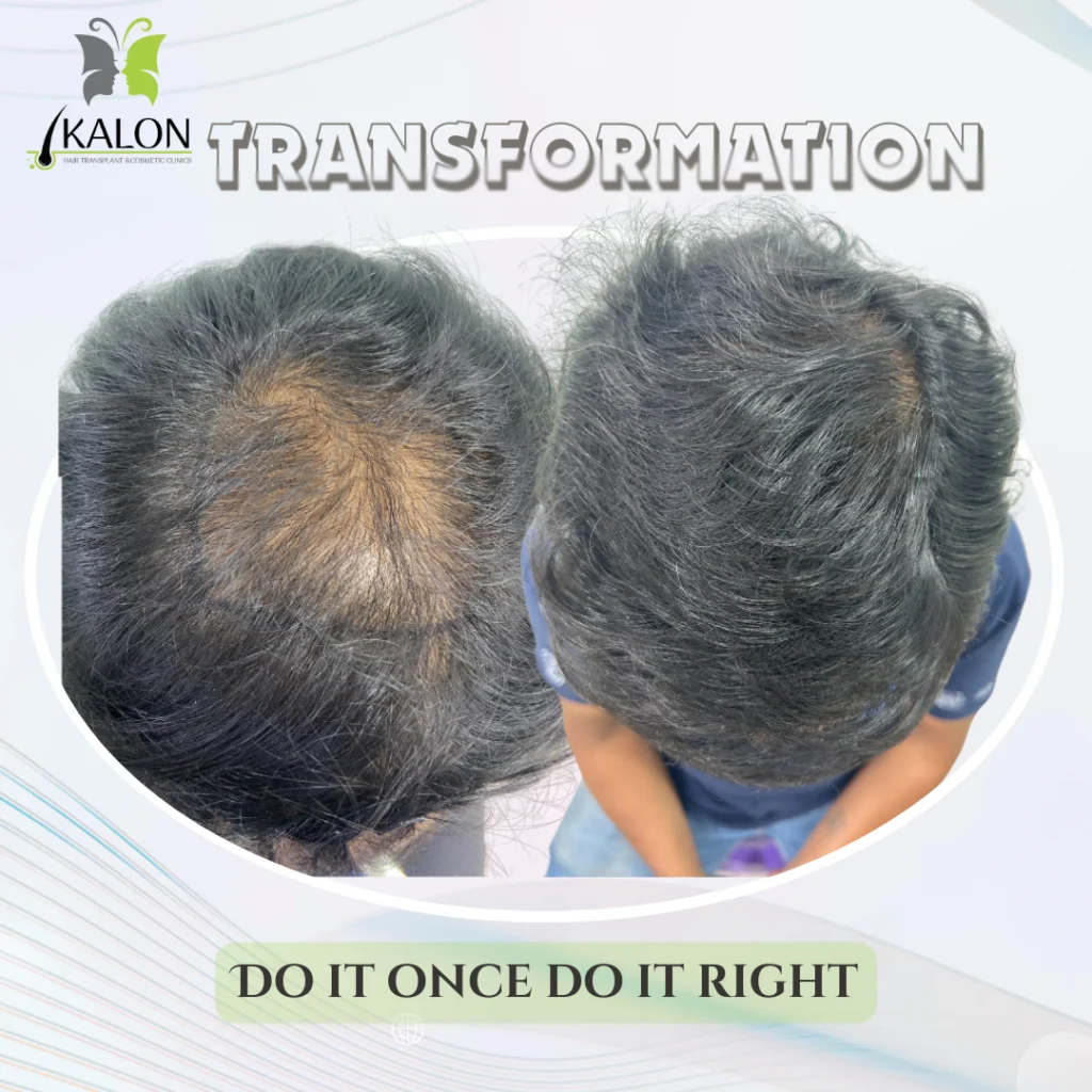 best hair transplant clinic in visakhapatnam