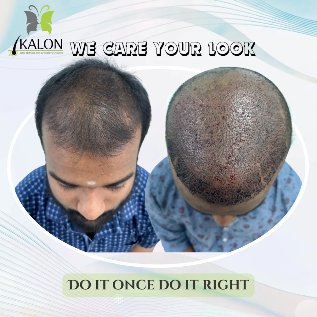 best hair transplant clinic in visakhapatnam