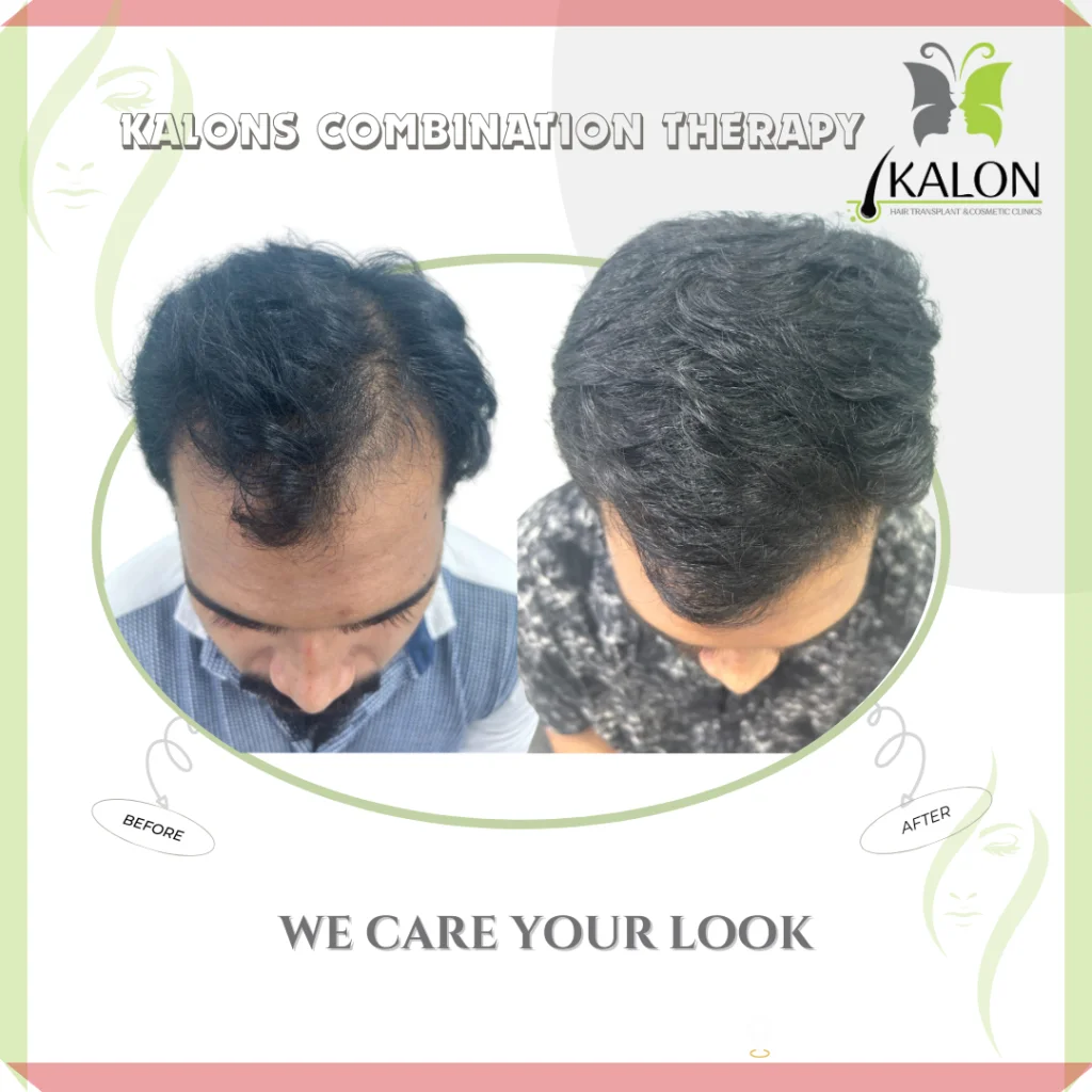 best hair transplant clinic in visakhapatnam