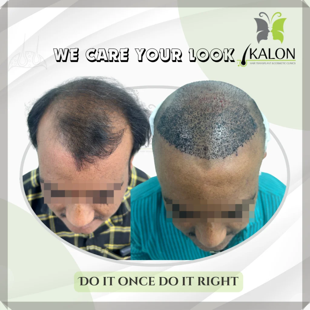 best hair transplant clinic in visakhapatnam
