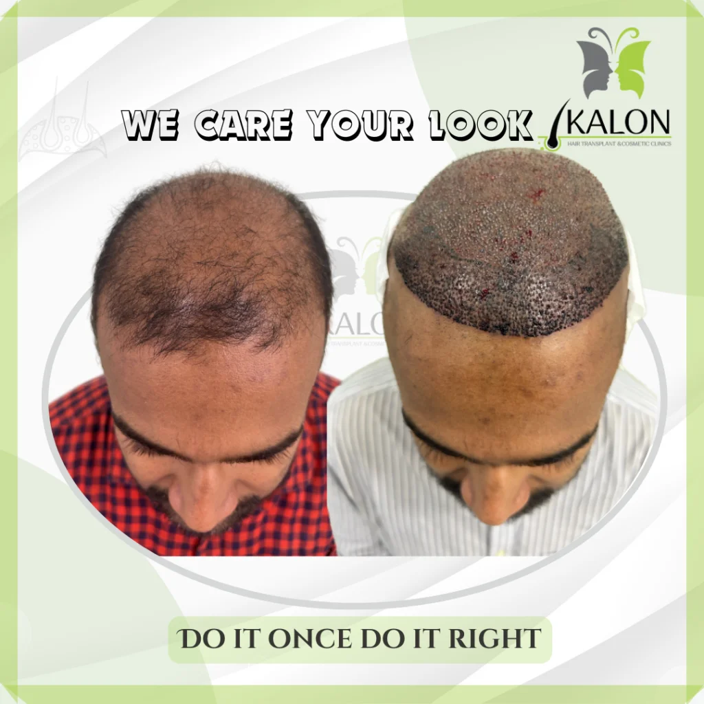 best hair transplant clinic in visakhapatnam