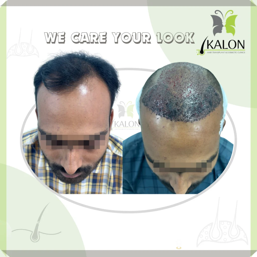 best hair transplant clinic in visakhapatnam