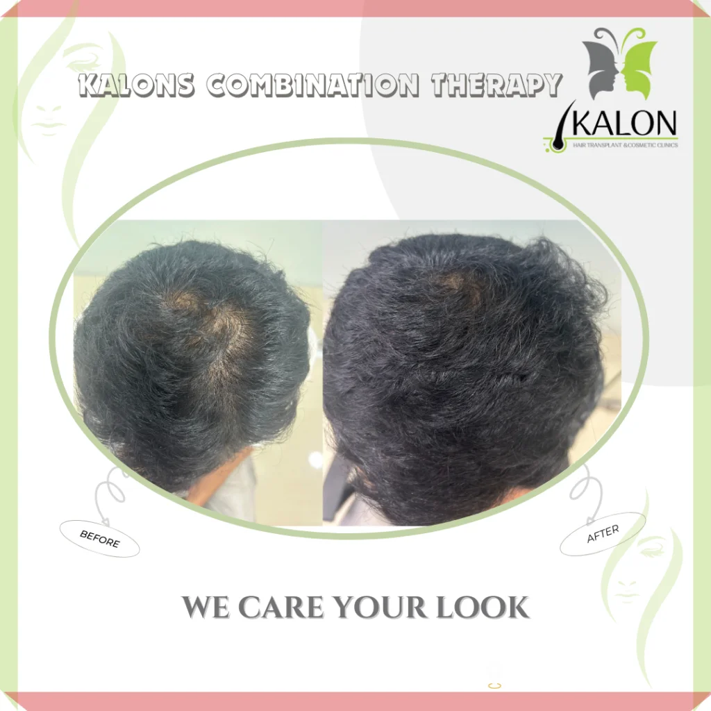 best hair transplant clinic in visakhapatnam