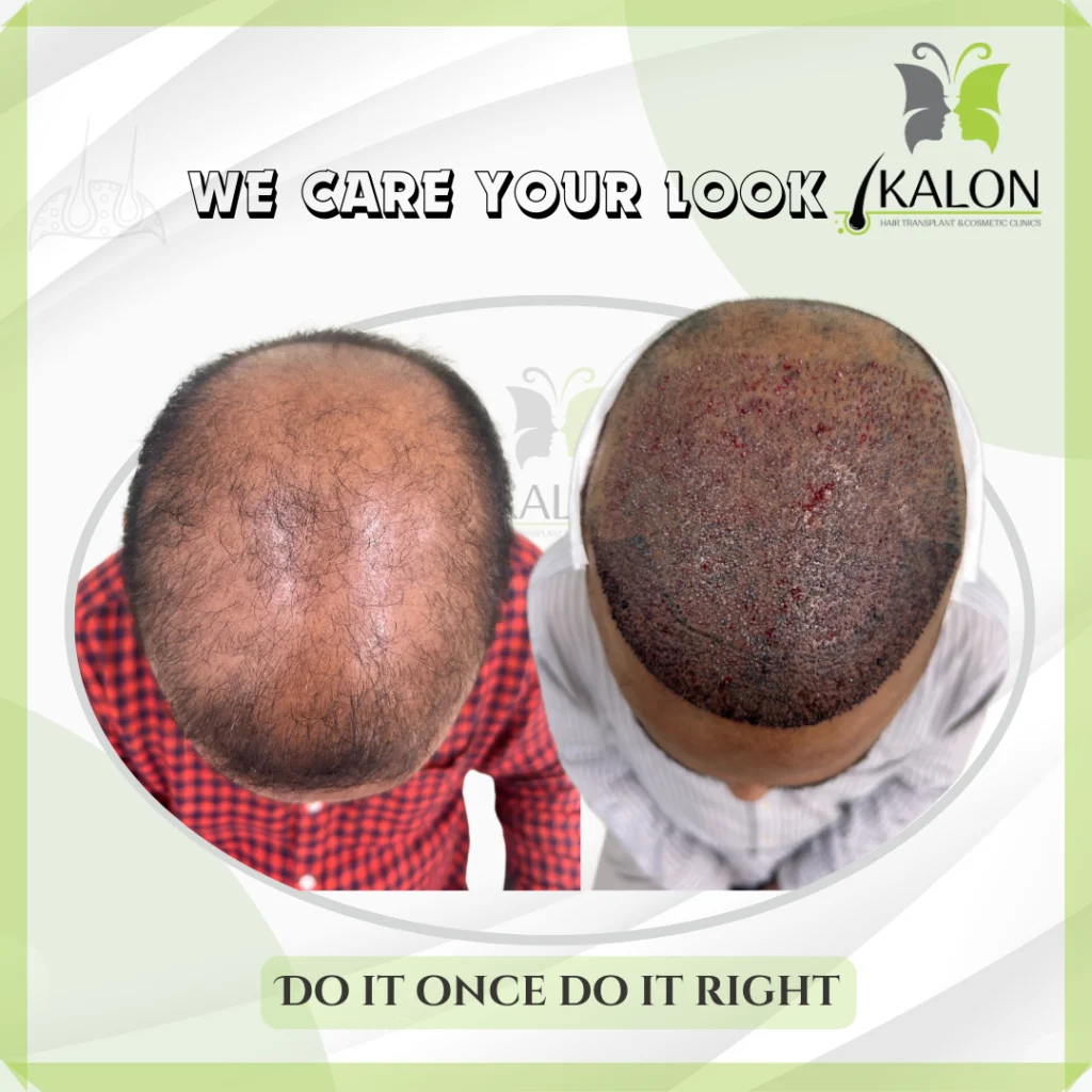 best hair transplant clinic in visakhapatnam