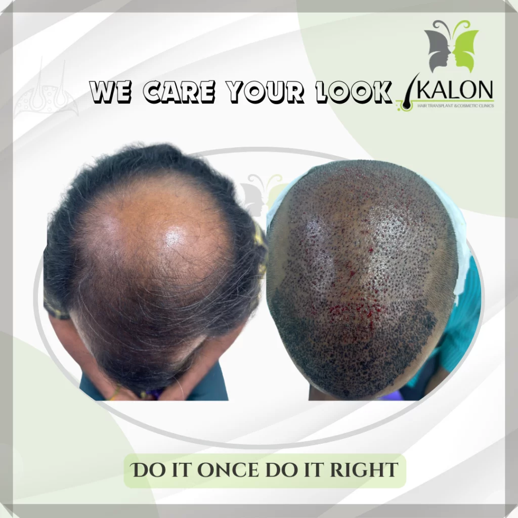 best hair transplant clinic in visakhapatnam