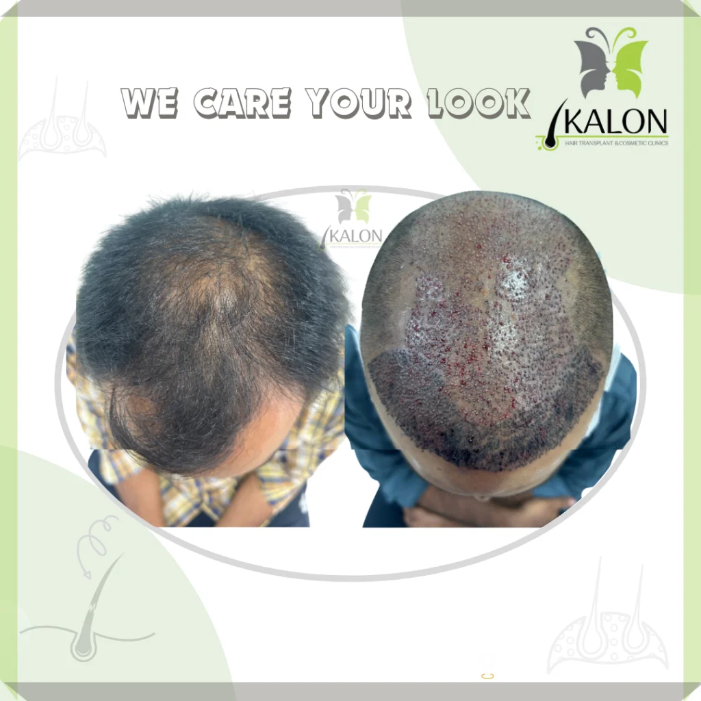 best hair transplant clinic in visakhapatnam