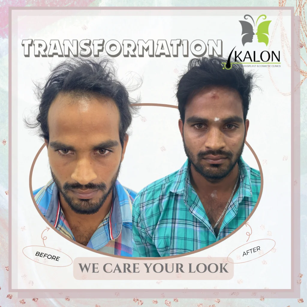 best hair transplant clinic in visakhapatnam