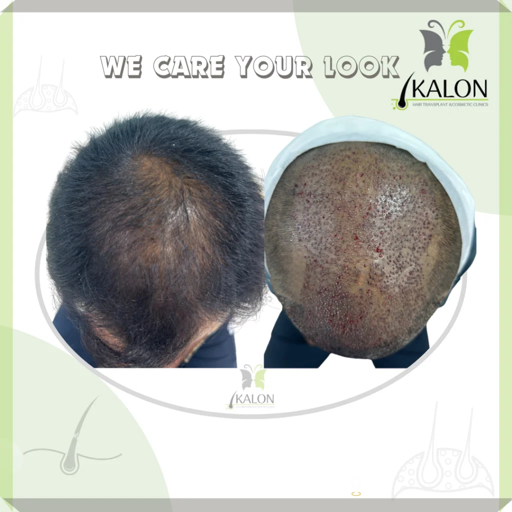 best hair transplant clinic in visakhapatnam