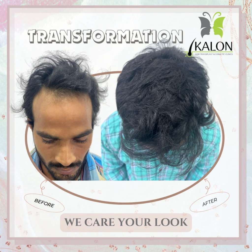 best hair transplant clinic in visakhapatnam