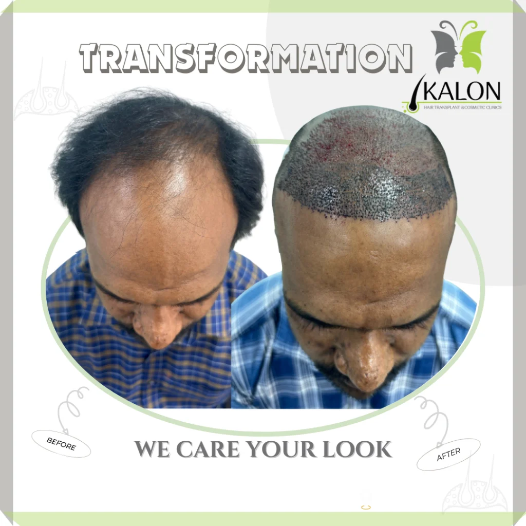best hair transplant clinic in visakhapatnam