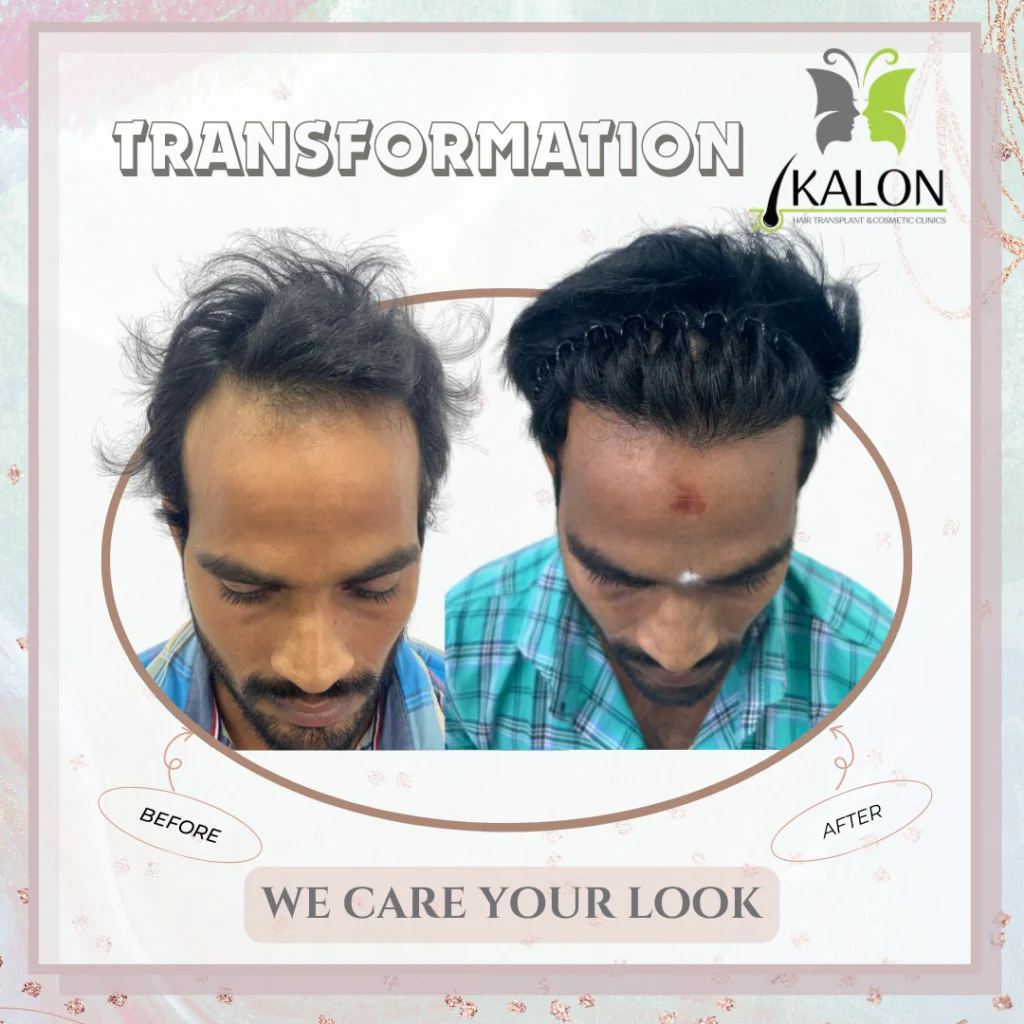 best hair transplant clinic in visakhapatnam