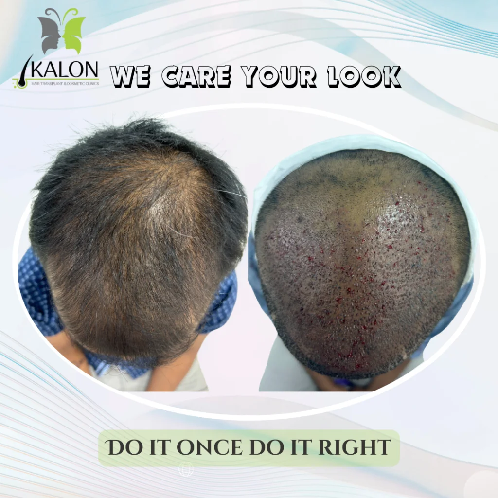best hair transplant clinic in visakhapatnam