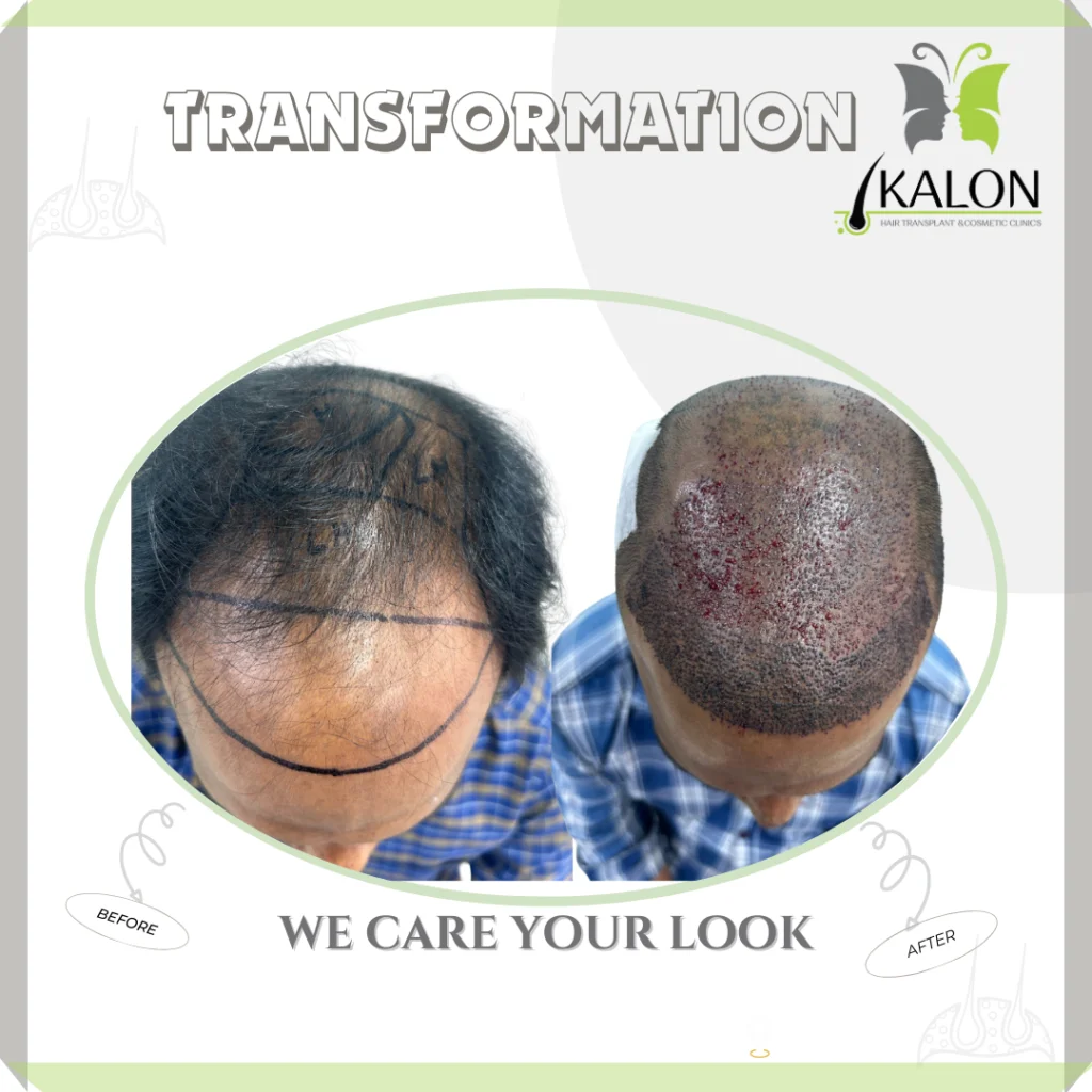 best hair transplant clinic in visakhapatnam