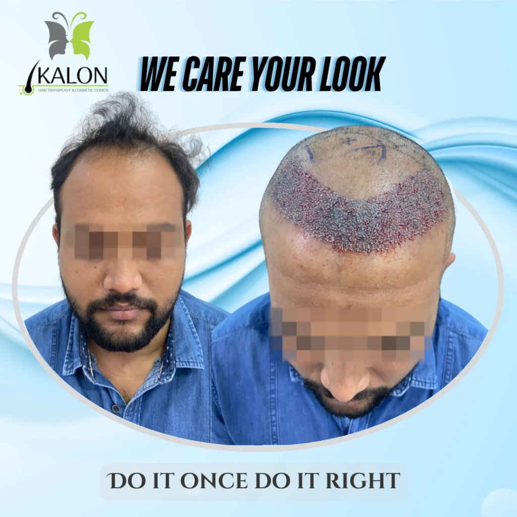 hair transplant