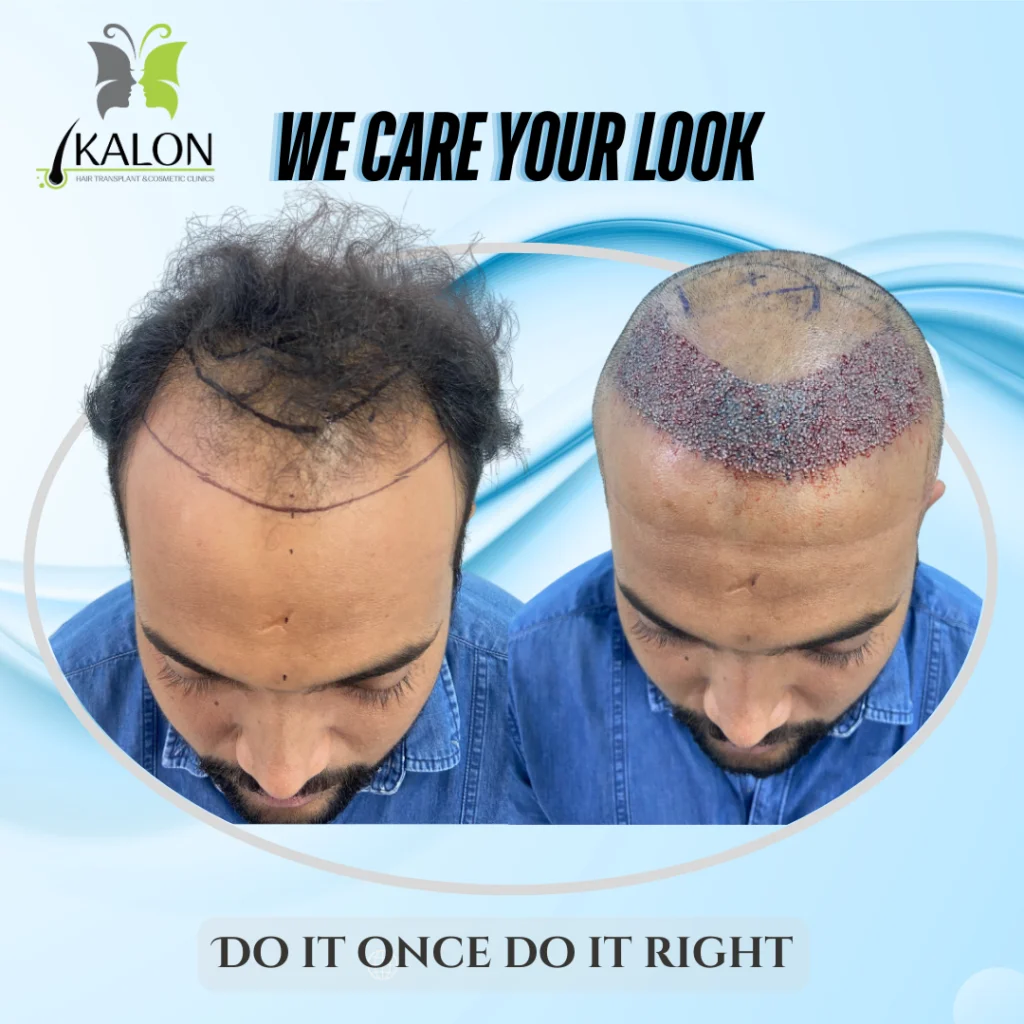 hair transplant
