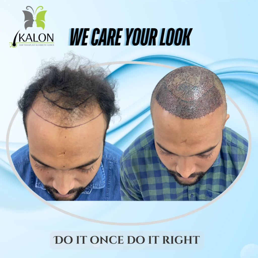 hair transplant
