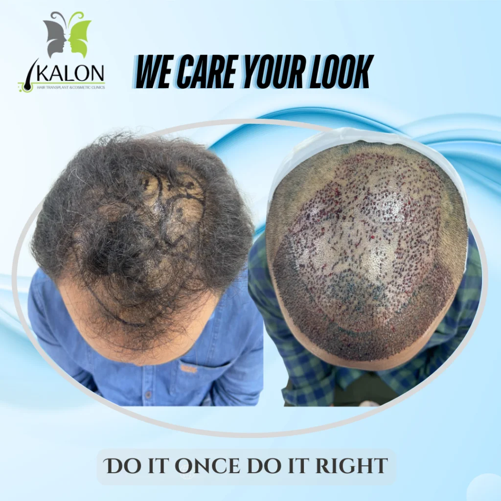 hair transplant