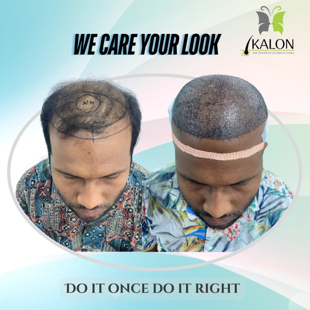 hair transplant