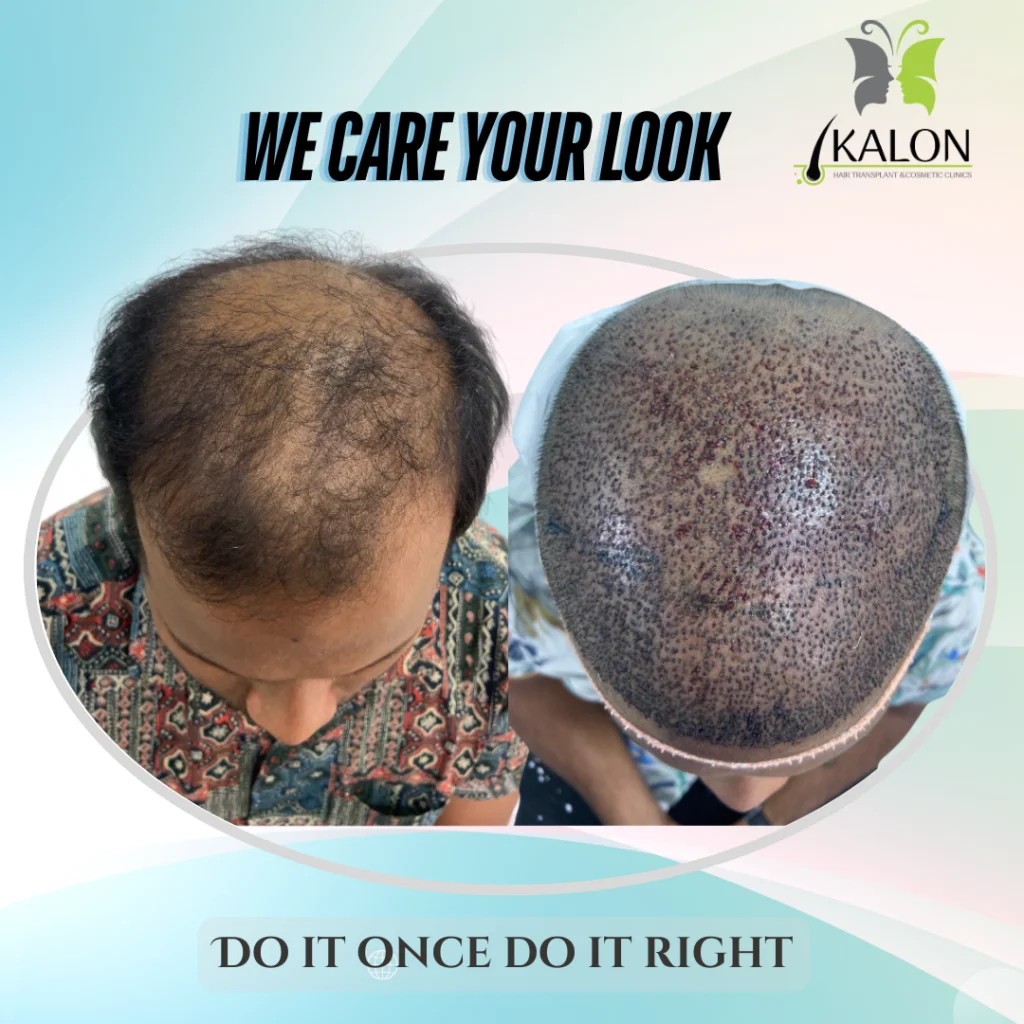 hair transplant