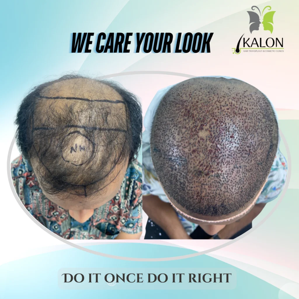 hair transplant
