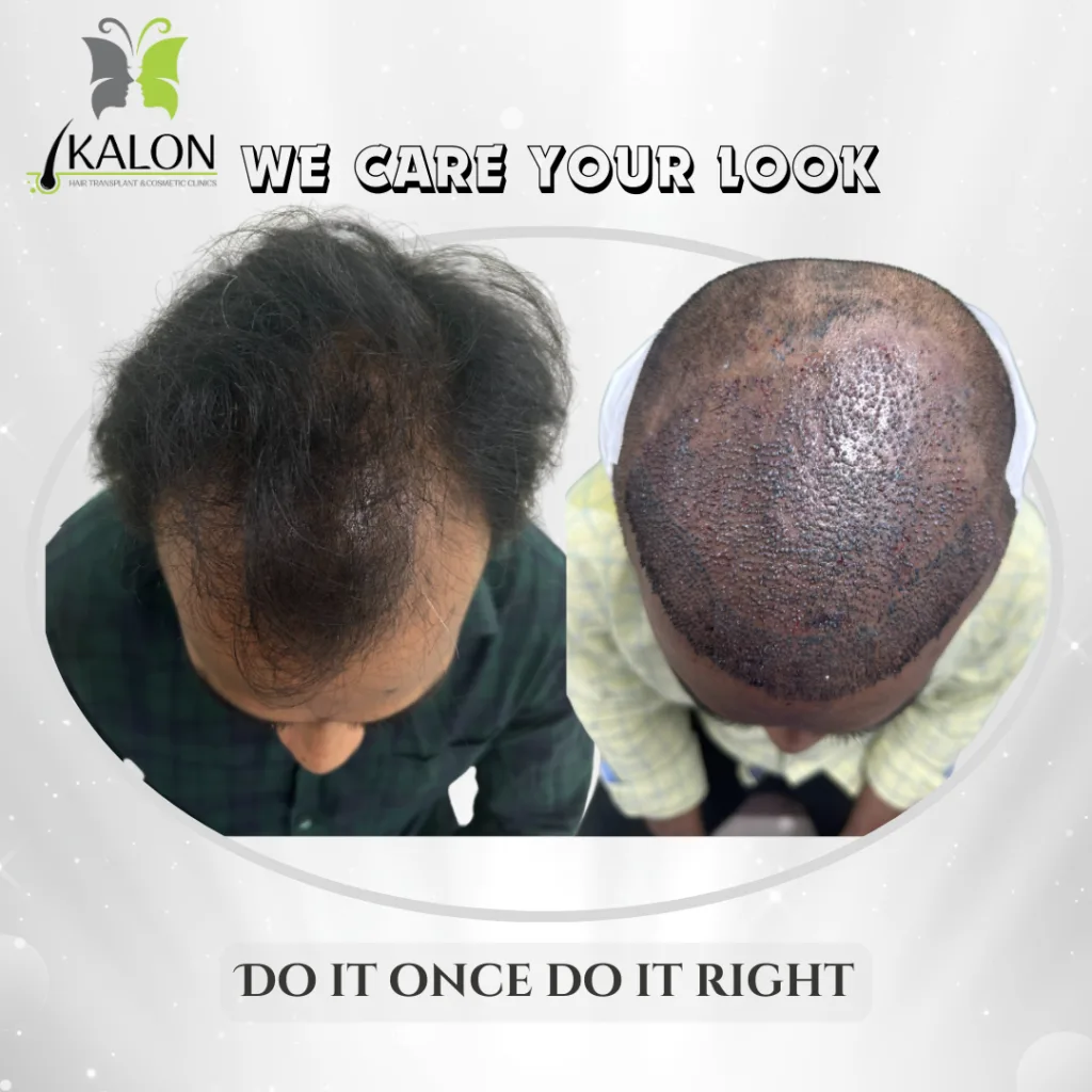 hair transplant