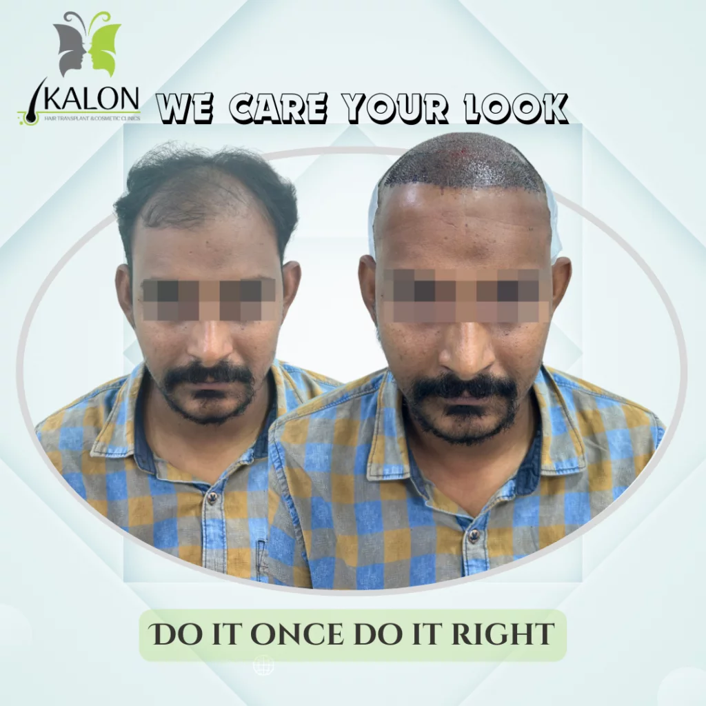 hair transplant