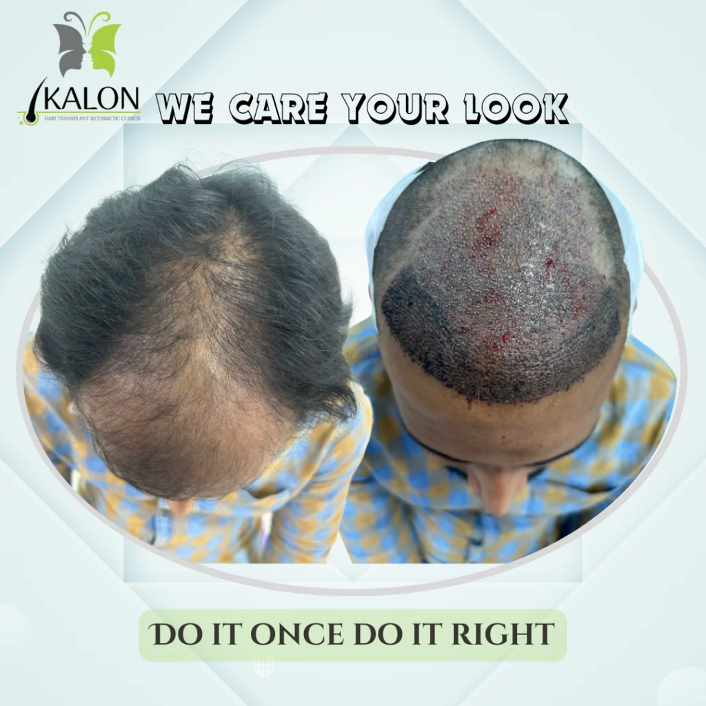 hair transplant