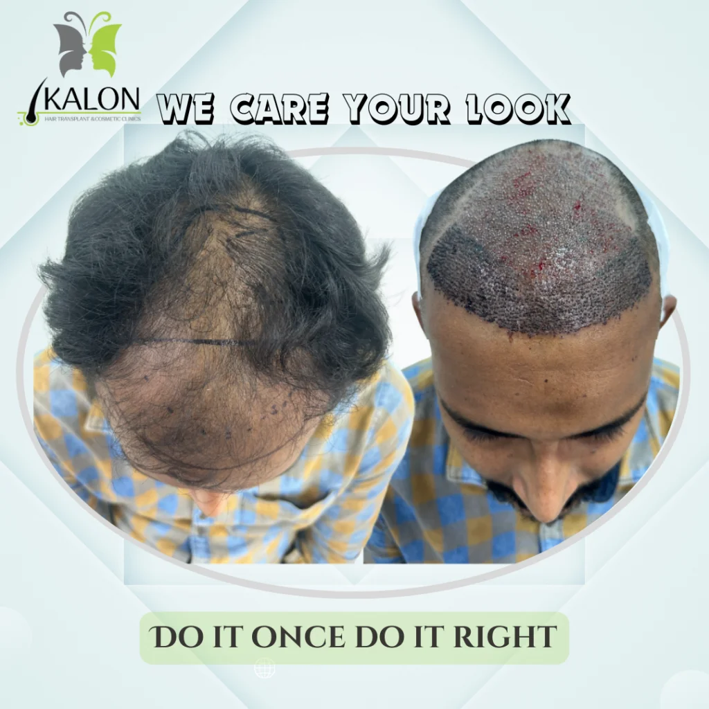 hair transplant