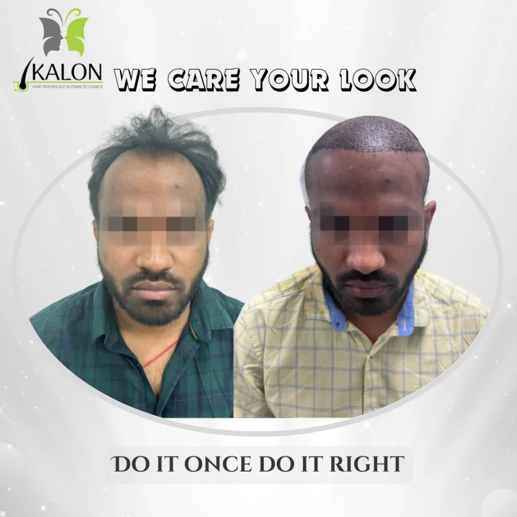 hair transplant
