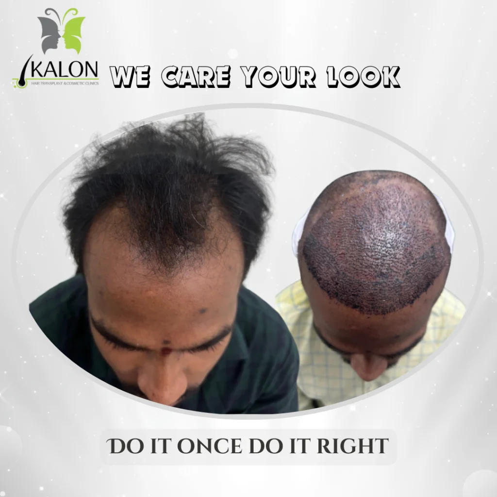 hair transplant