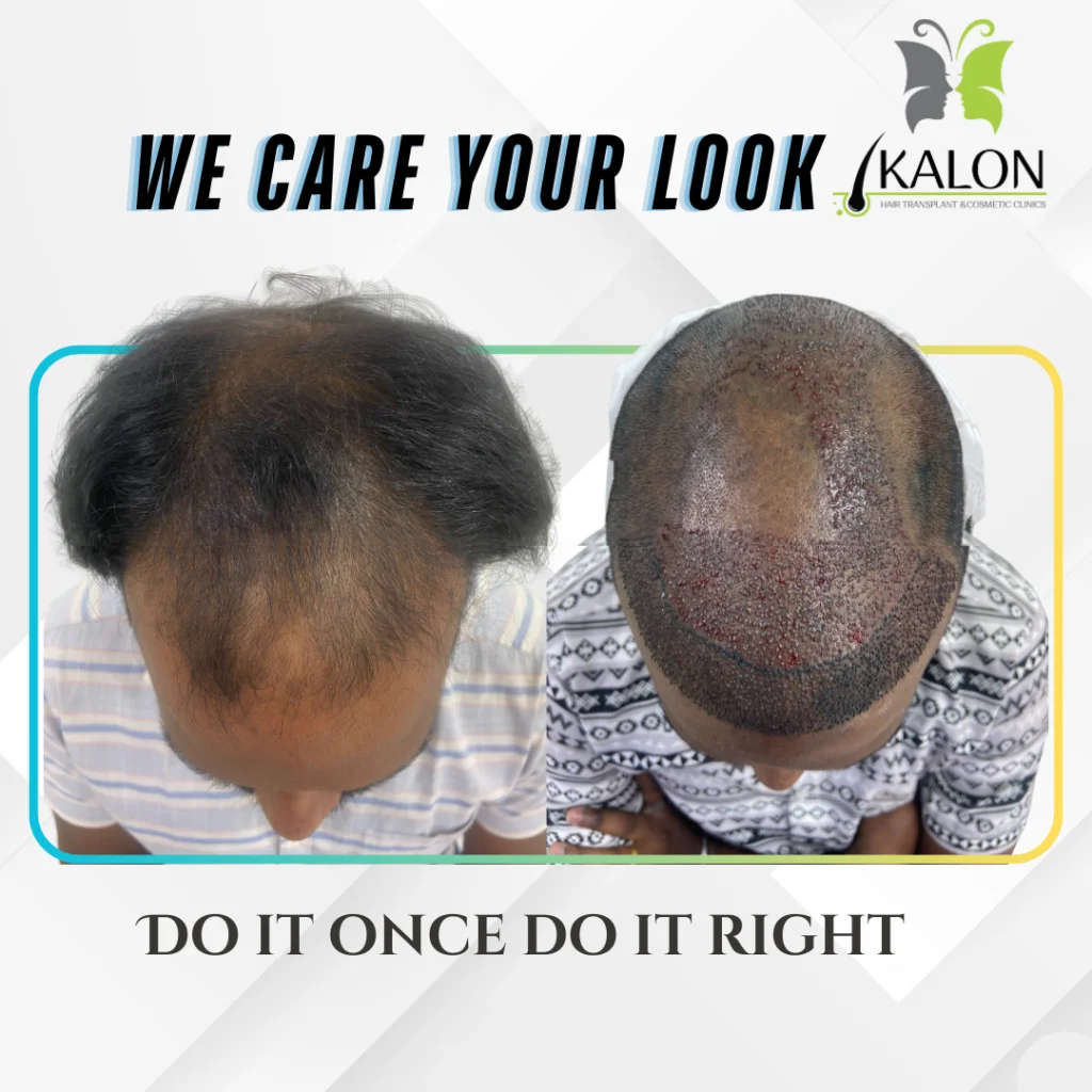 hair transplant clinic in visakhapatnam