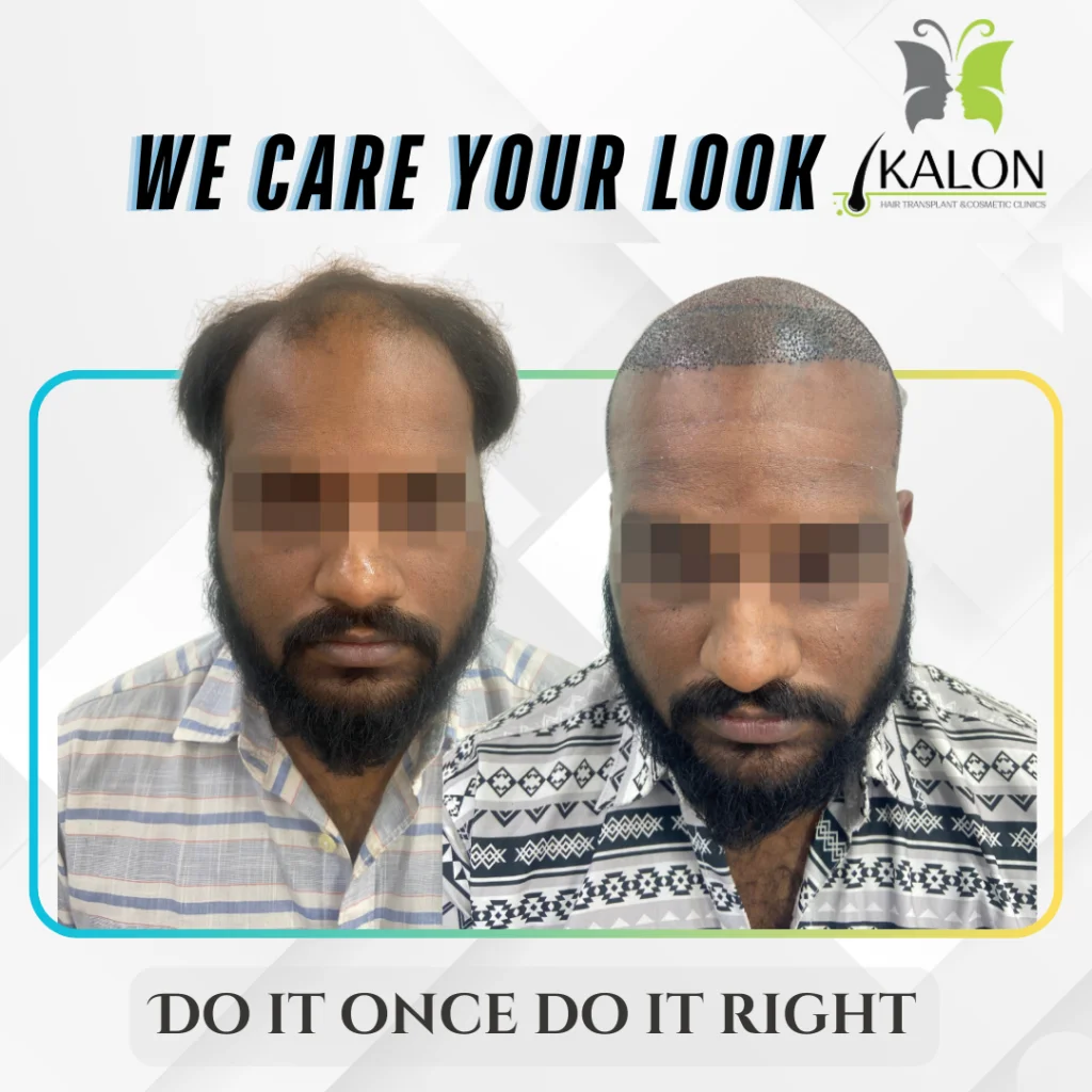 hair transplant clinic in visakhapatnam
