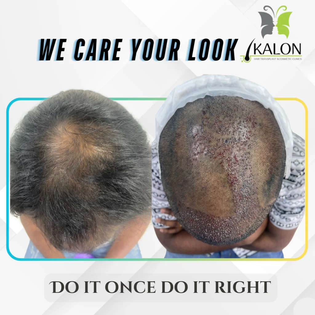 hair transplant clinic in visakhapatnam