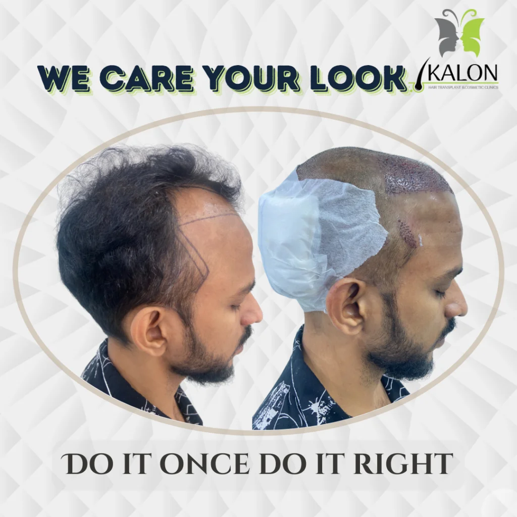 best hair transplant clinic in visakhapatnam