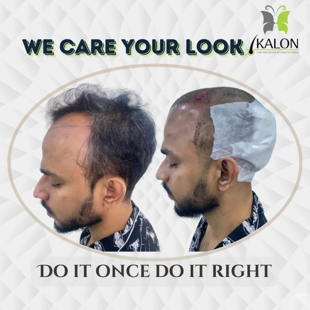 best hair transplant clinic in visakhapatnam