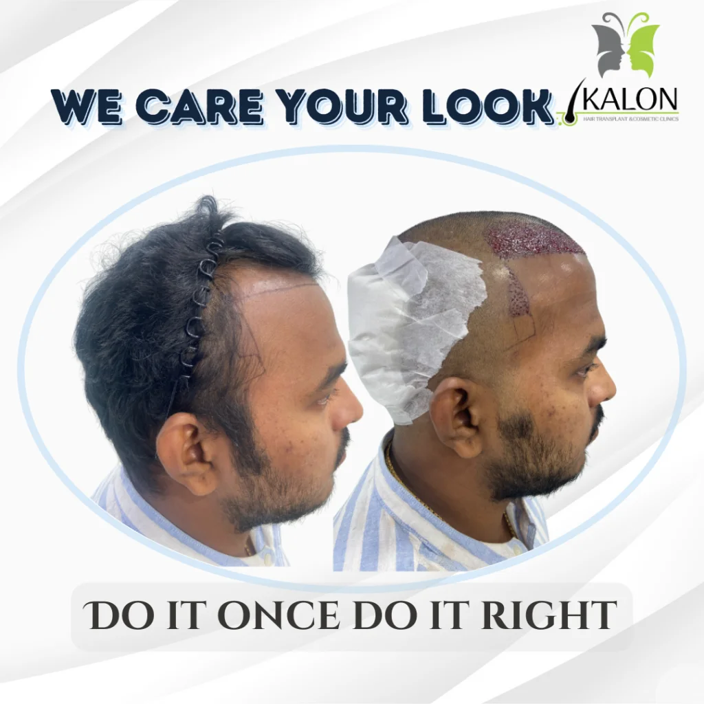 hair transplant clinic in visakhapatnam