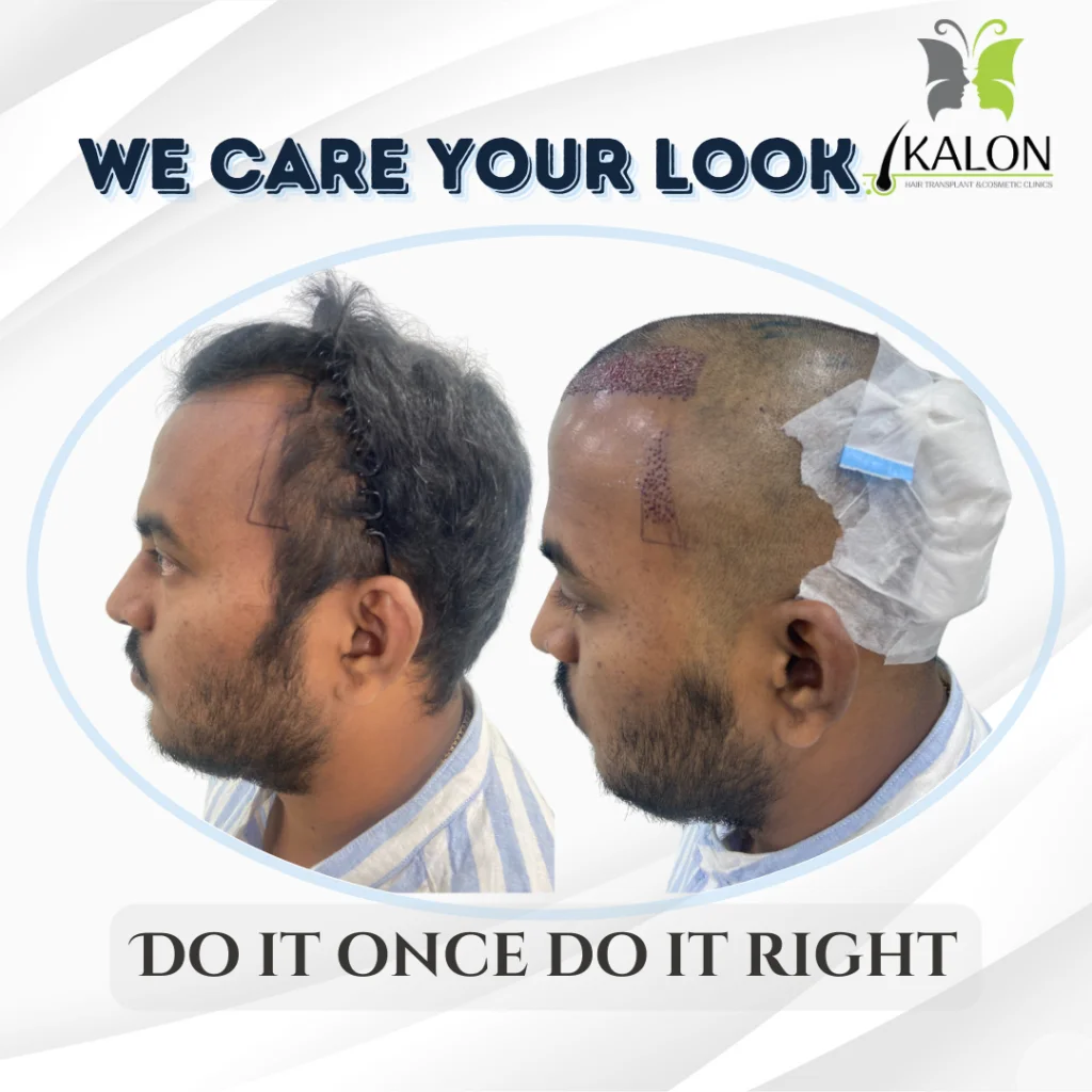 hair transplant clinic in visakhapatnam