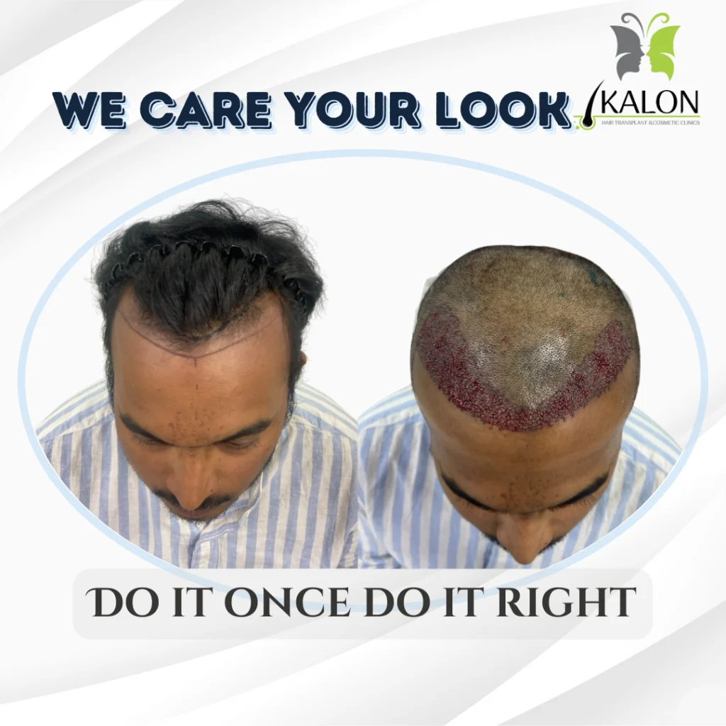 hair transplant clinic in visakhapatnam