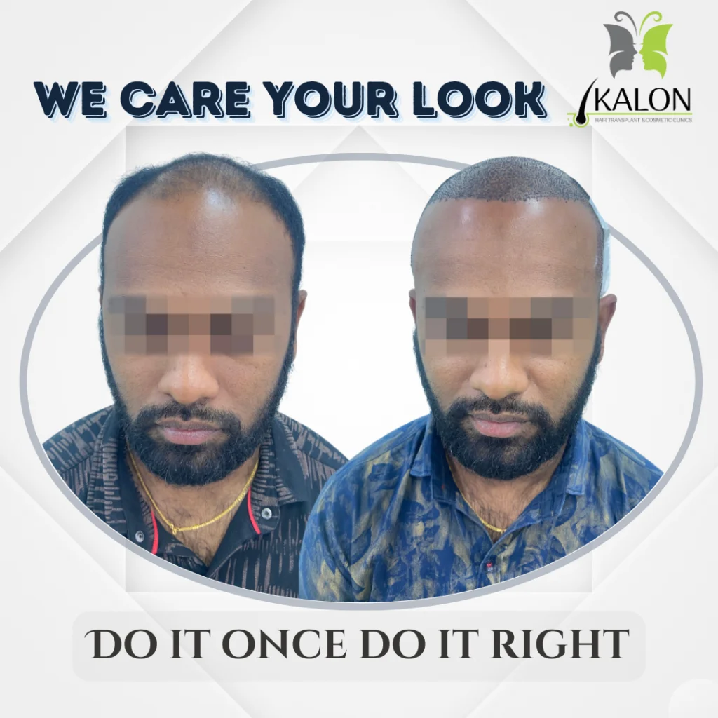 hair transplant clinic in visakhapatnam