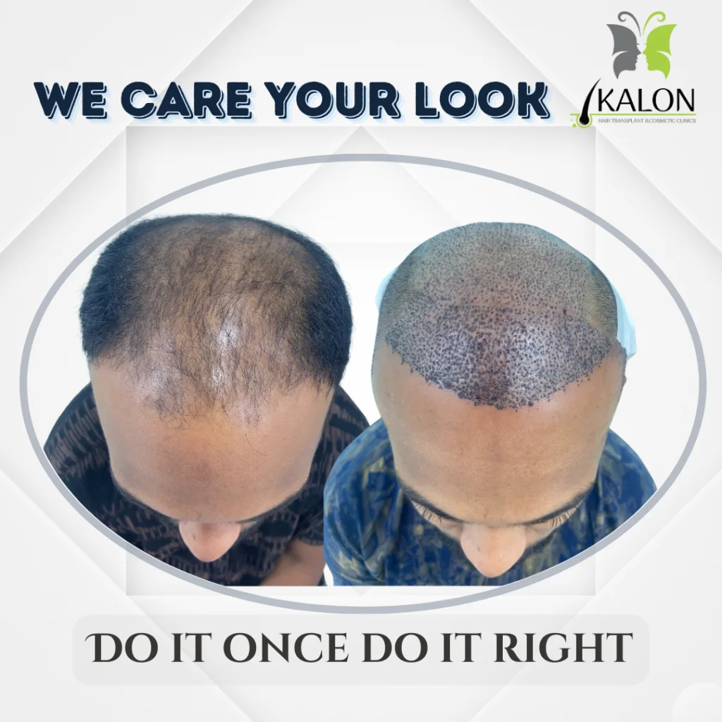 hair transplant clinic in visakhapatnam