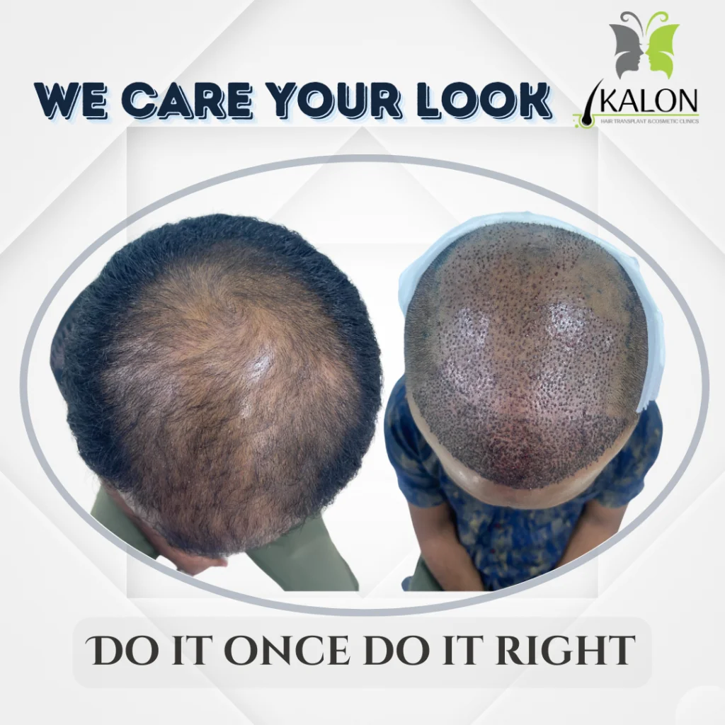 hair transplant clinic in visakhapatnam