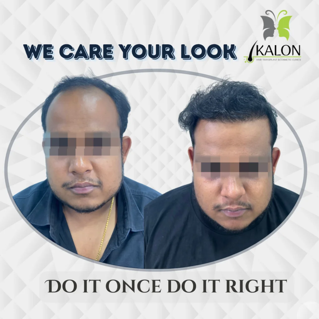 best hair transplant clinic in hyderabad
