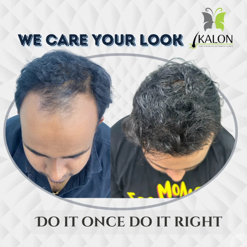 best hair transplant clinic in hyderabad