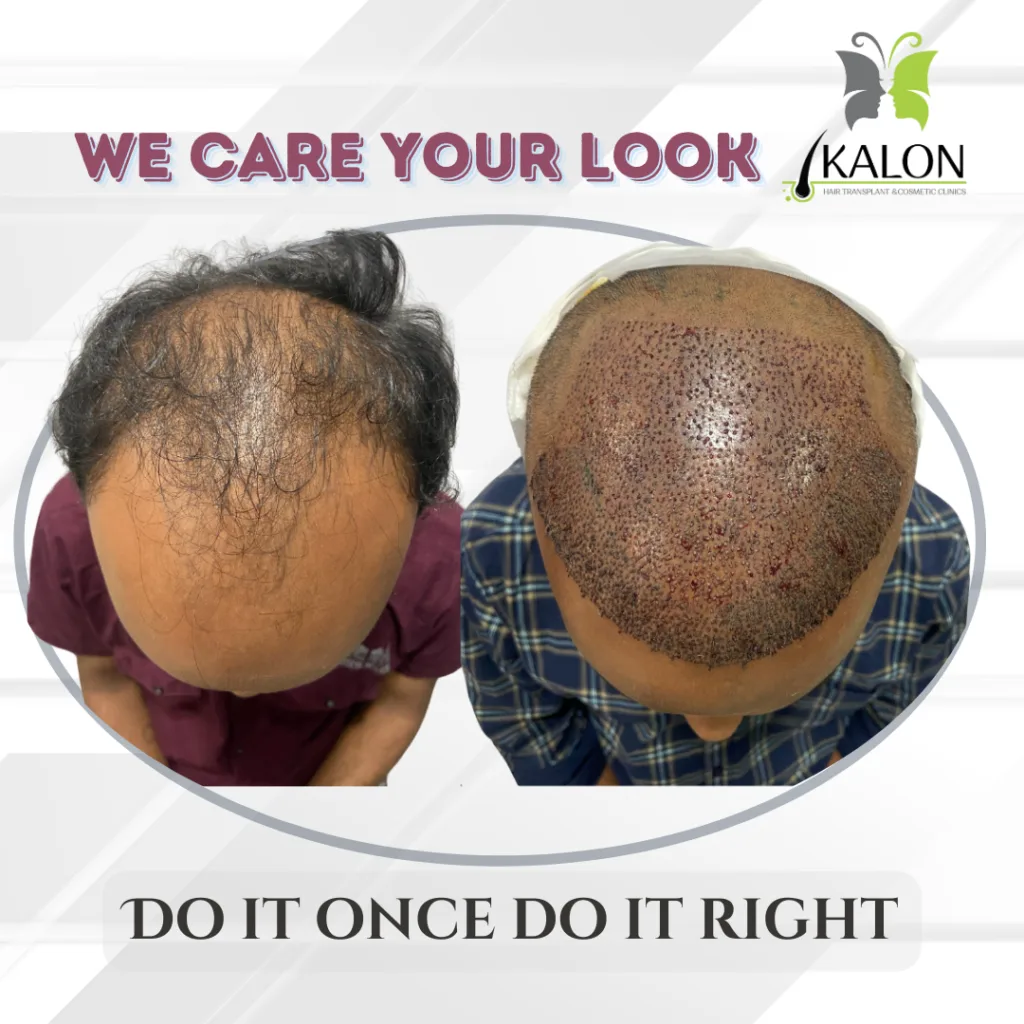 best hair transplant clinic in visakhapatnam